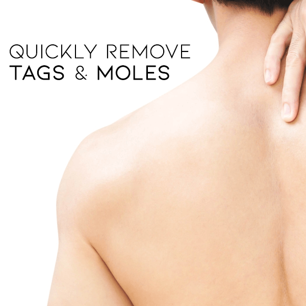 WipeOff Skin Tag & Mole Remover