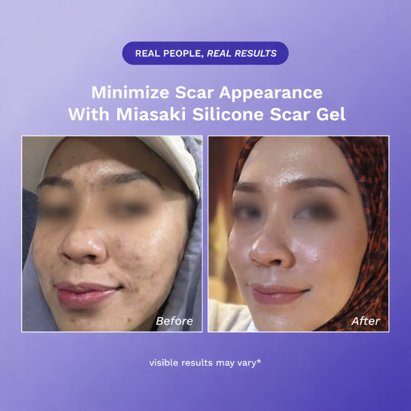 Miasaki Scar Repair Gel