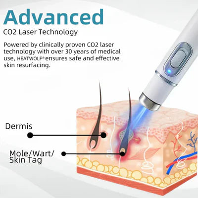 Bikenda® 🔥🔥 Non-Invasive Mole and Wart Removal Laser Pen